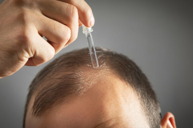 Balding – Warning signs, causes, and management options