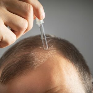 Balding – Warning signs, causes, and management options