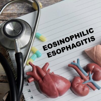 Key factors to know about eosinophilic esophagitis