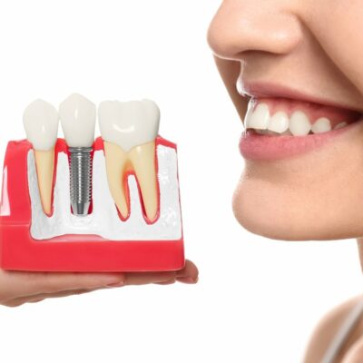 Ways to find affordable dental implants